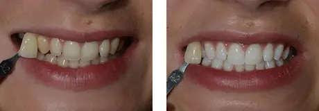 Bělení zubů s Pure Whitening (domácí i v ordinaci - kombinované)
