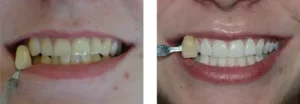 Bělení zubů s Pure Whitening (domácí i v ordinaci - kombinované)